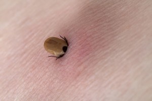 A tick stuck in the arm skin in Summer